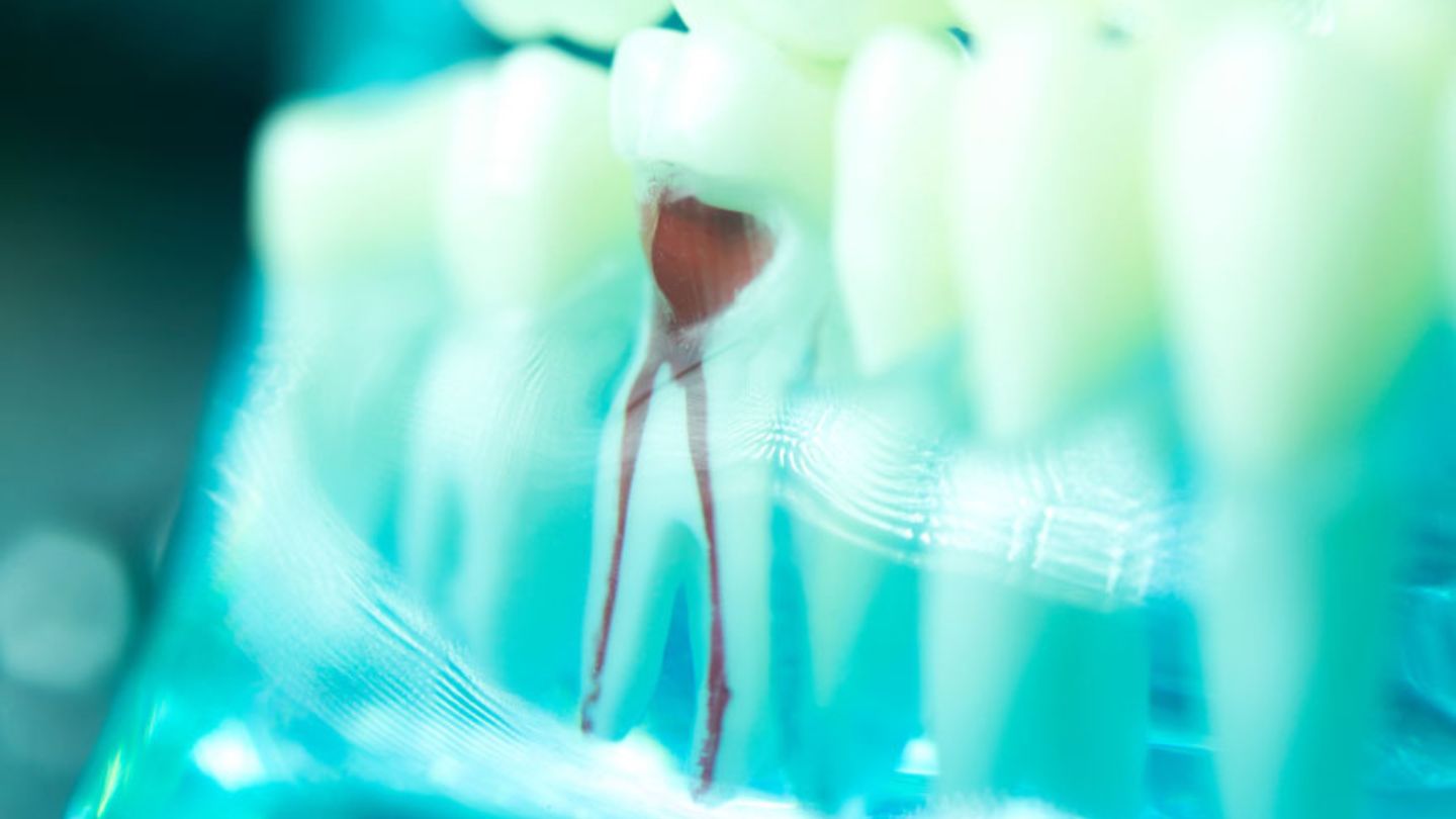 How Long Do Root Canals Last ?
