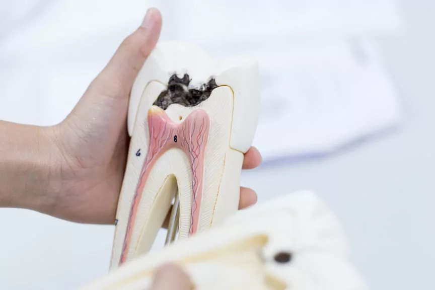 A Hand Holding A Cross-sectional Model Of A Decayed Tooth
