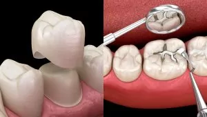 Filling vs. Crown: How Dentists Choose the Right Repair