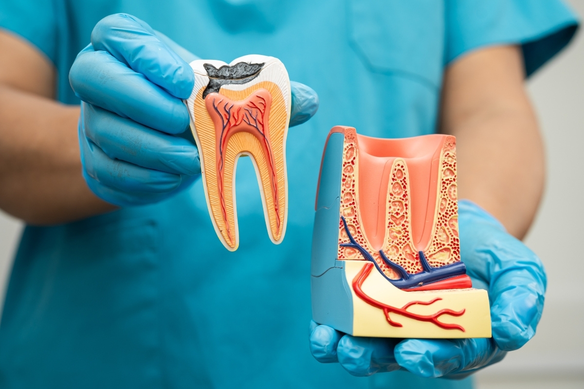 Dental model showing tooth decay stages and treatment to save damaged teeth